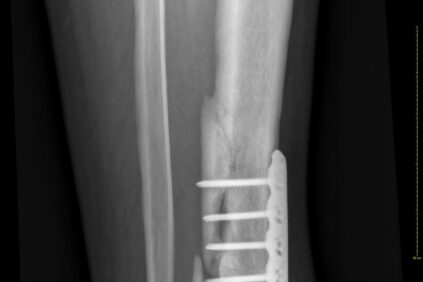 no-uniones-y-pseudoartrosis