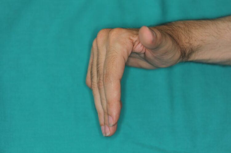 Recuperacion de la movilidad-2