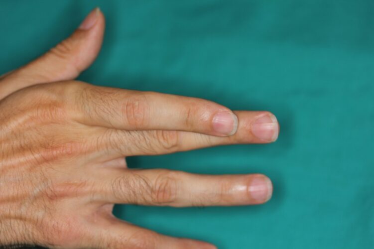 Recuperacion de la movilidad de la musculatura dependiente del nervio cubital seccionado.