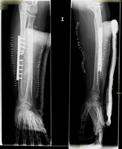 Imagen inmediata tras la tercera cirugía con aporte de hueso vascularizado de la rodilla