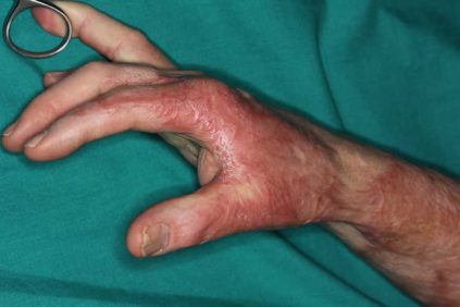 piel cicatricial tras quemadura que limita casi por completo  la movilidad de muñeca  y primer y según dedos