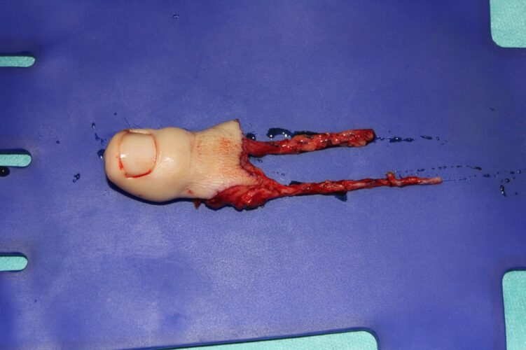 Disección del primer dedo del pie