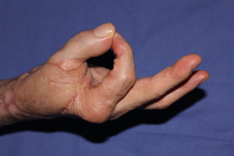 Resultado tras la reconstrucción (5)